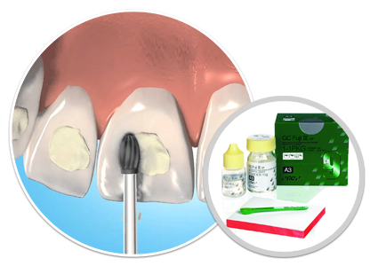 مواد مصرفی دندانپزشکی
